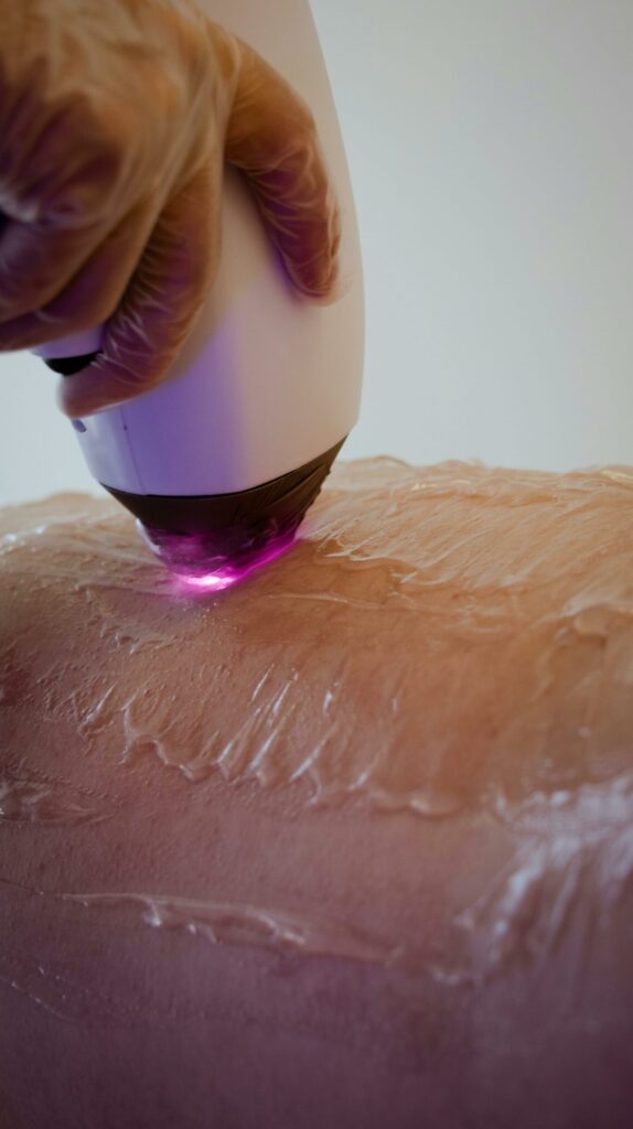 SonderBeaut laser hair removal