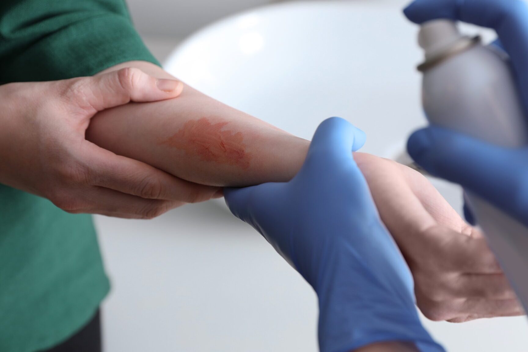 burn on arm