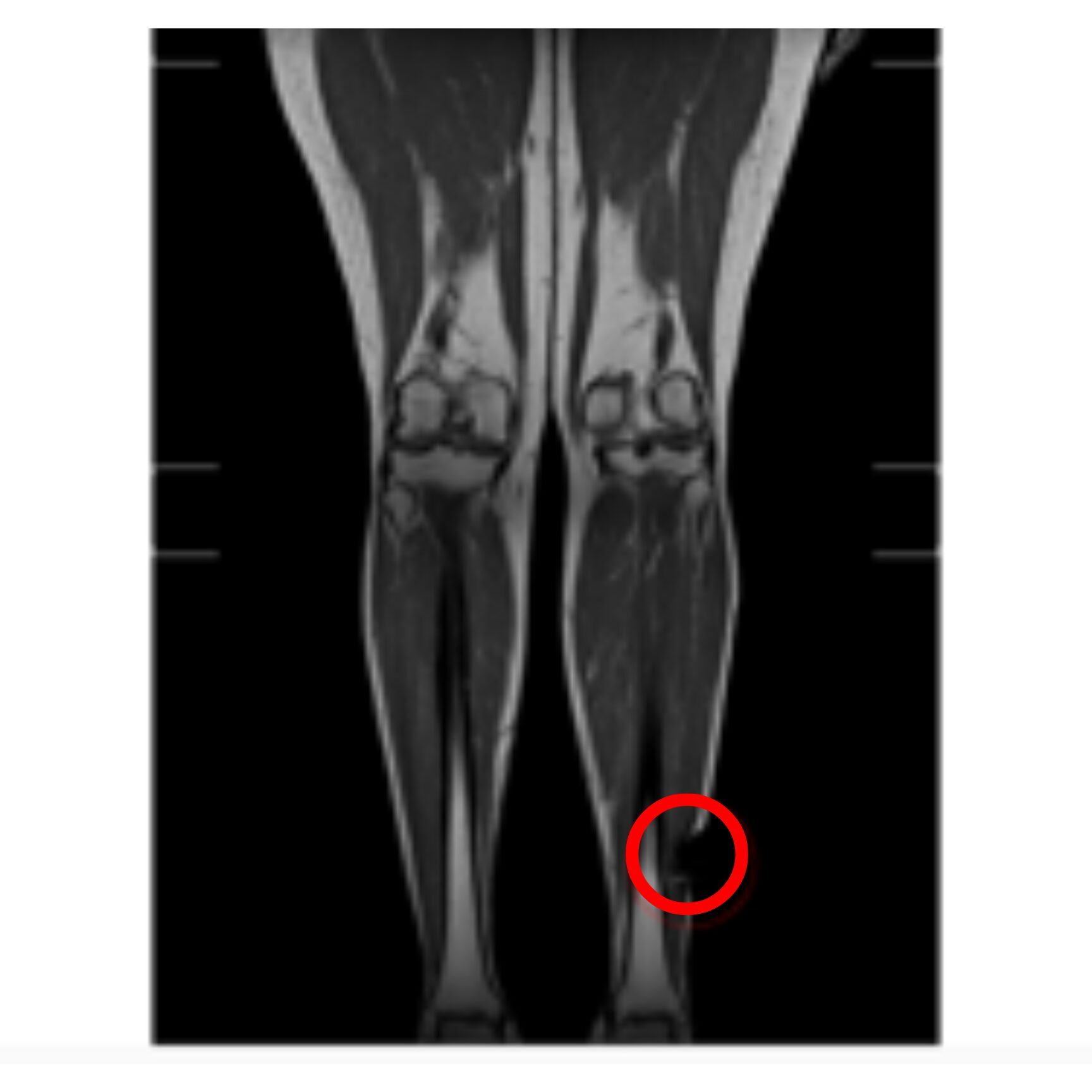 mri of legs 