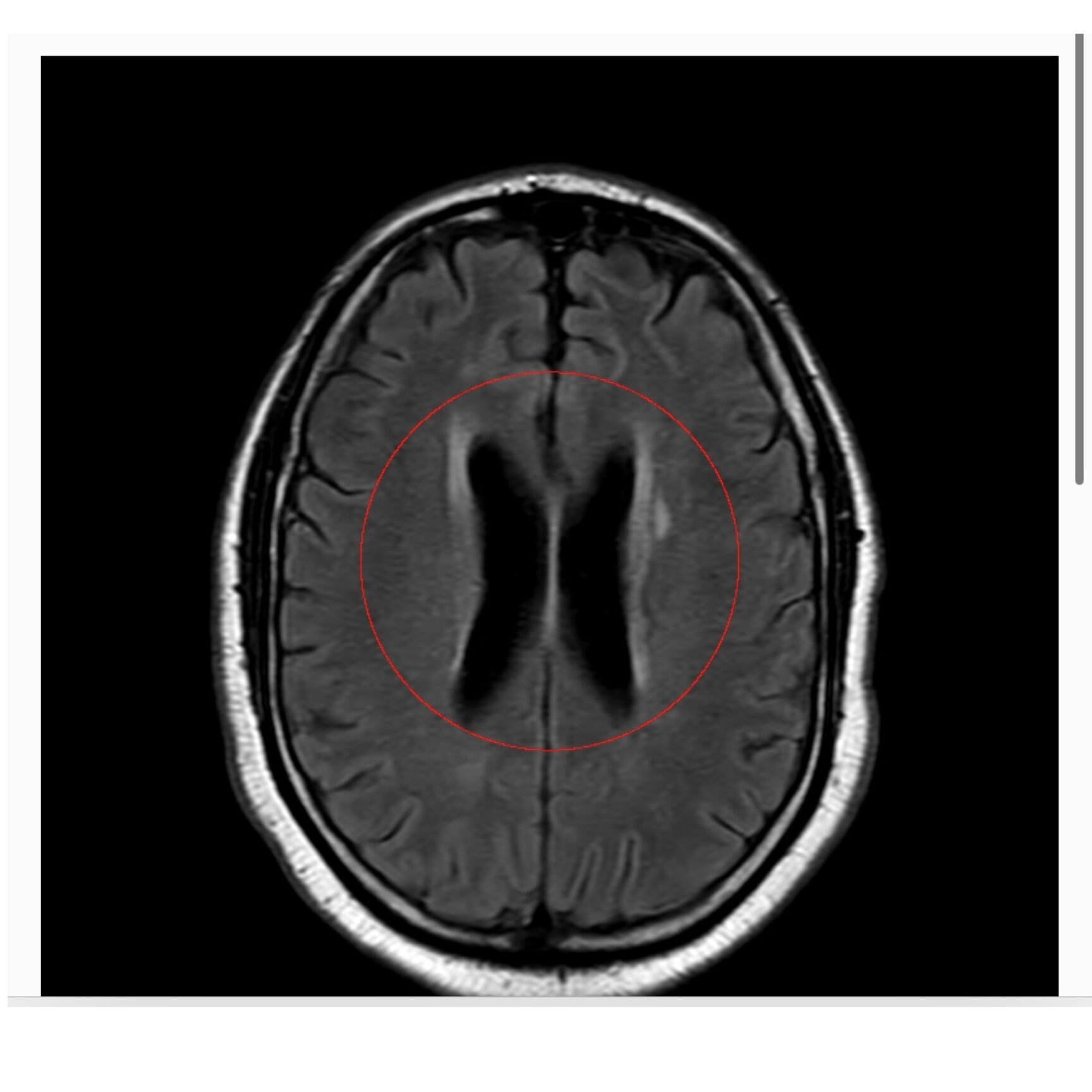 brain small vessel ischemia