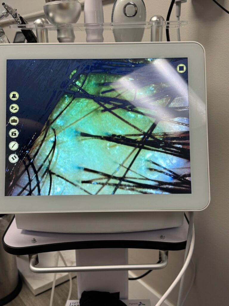 SonderBeaut microscope on hair follicles